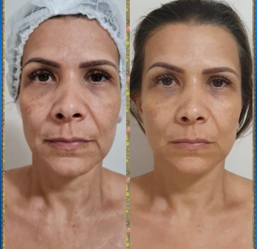 Resultado Protocolo Premium 2
