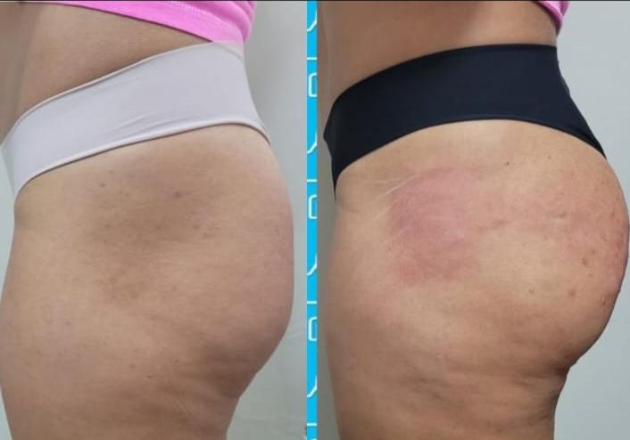 Resultado Harmonização Glútea — Dra. Deyse de Paula
