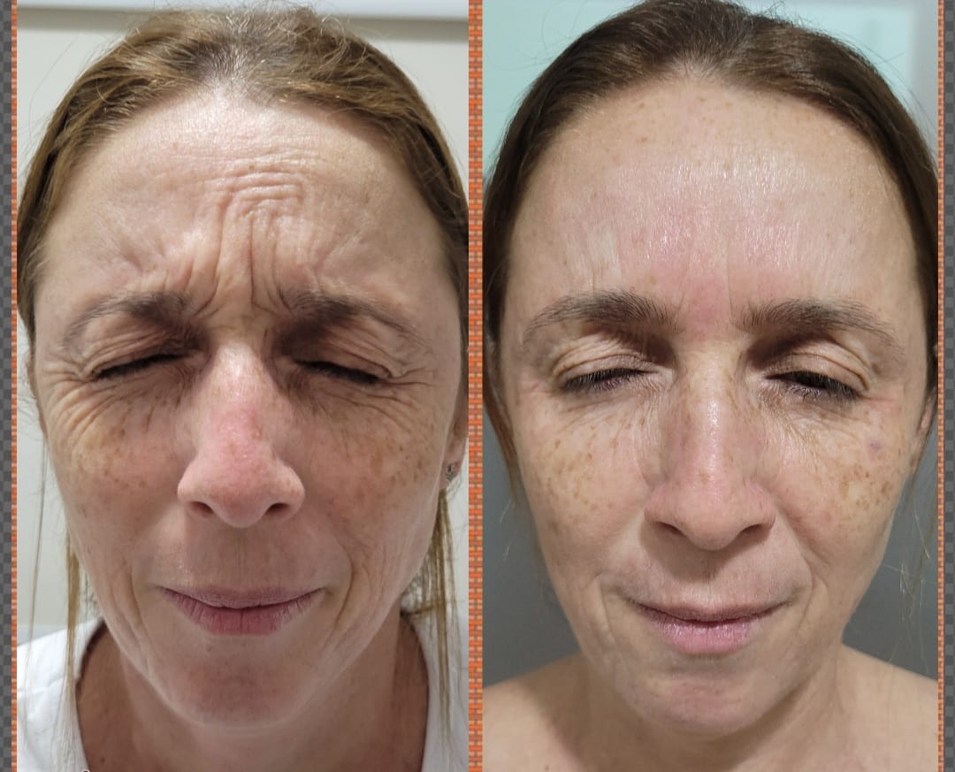 Resultado Antes e Depois Protocolo Premium