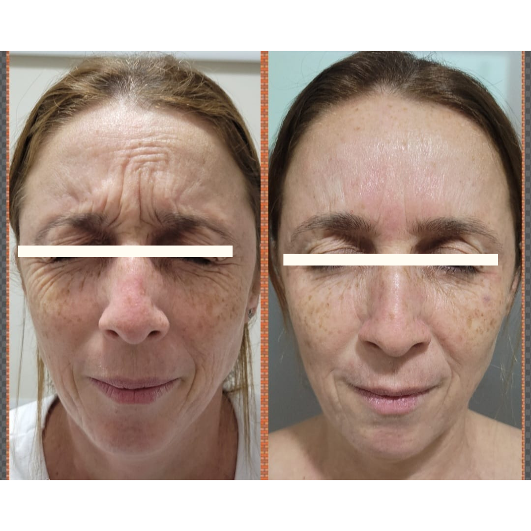 Resultado Rejuvenescimento Facial
